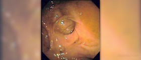 Diverticulitis symptoms review