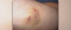 Dog bite infection