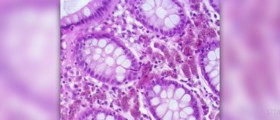 Don't ignore colon cancer warning signs
