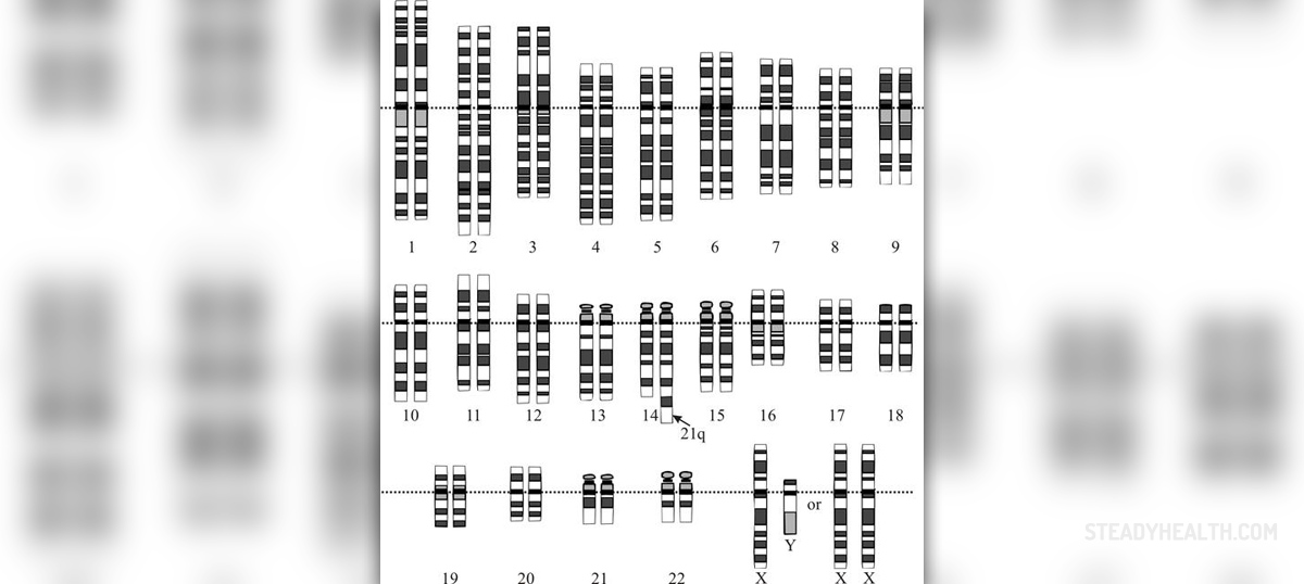 Down Syndrome Milestones Chart