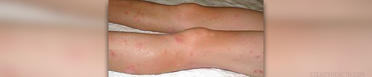 Dry Skin Bumps On Legs Skin Hair Problems Articles Body Health Conditions Center Steadyhealth Com
