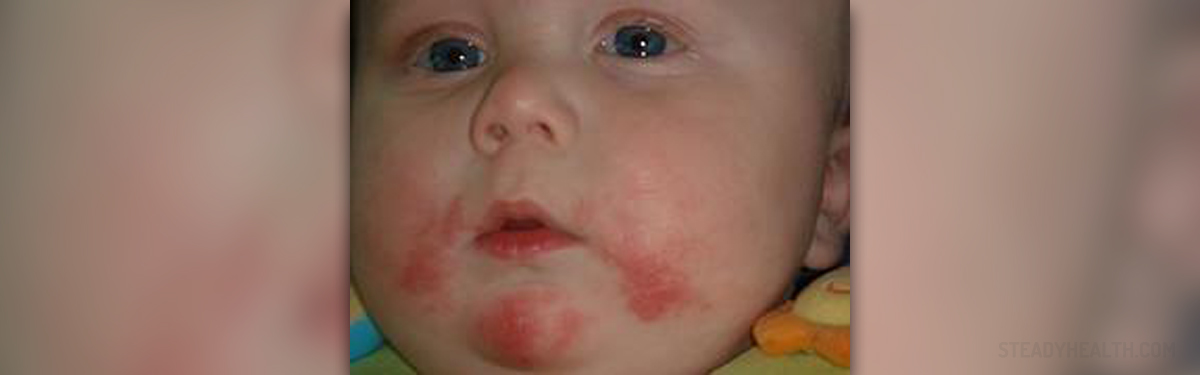 dry-skin-conditions-in-babies-children-s-teens-health-articles