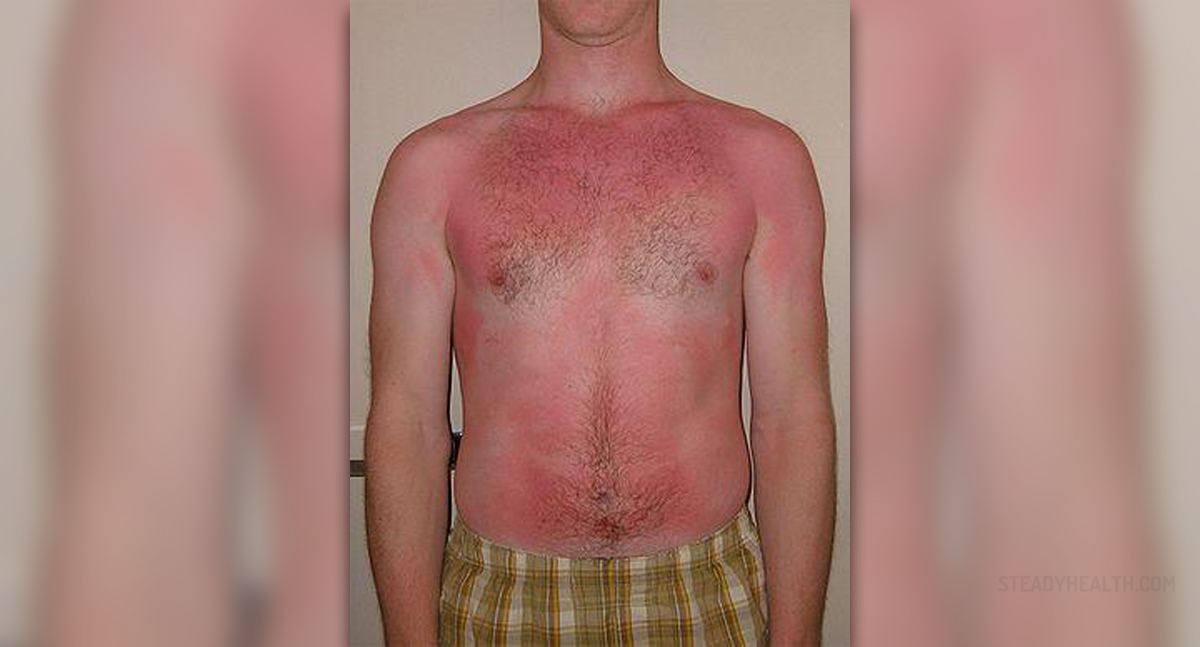 why-does-skin-peel-after-sunburn-livestrong-com