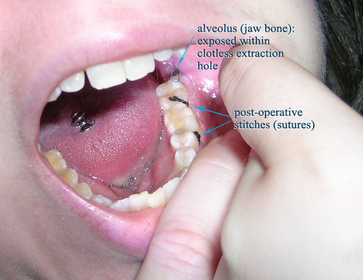 10-how-long-does-it-take-wisdom-teeth-holes-to-heal-references