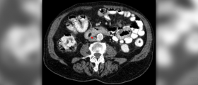 Duodenal ulcer symptoms