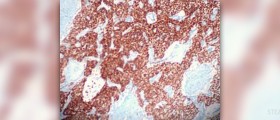 Dysfunctional uterine bleeding