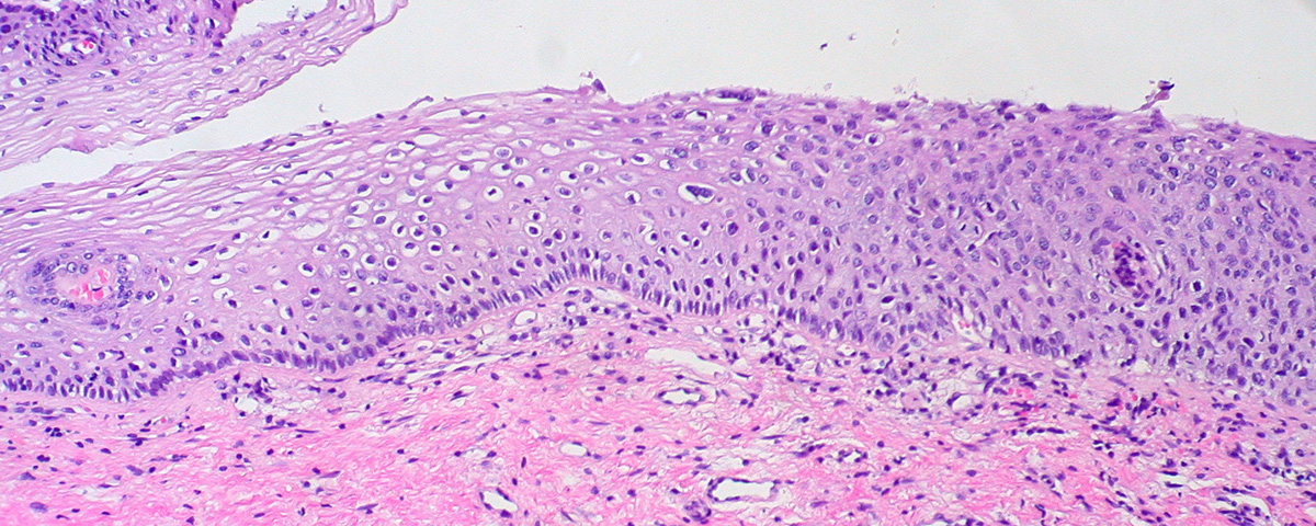 Cervical Dysplasia - Pictures