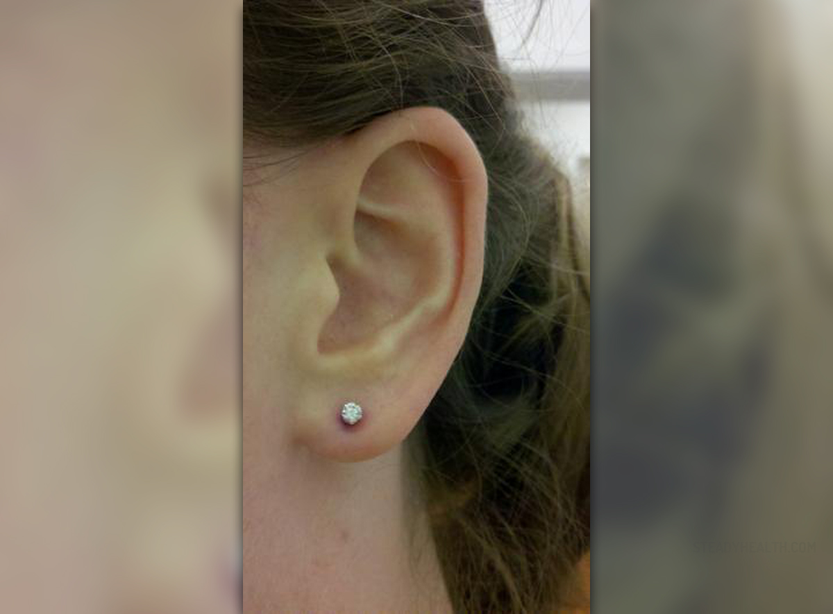 ear-piercing-infection-general-center-steadyhealth