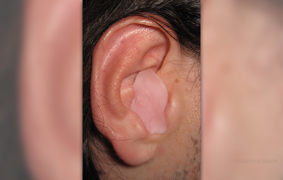 ear-wax-build-up-general-center-steadyhealth