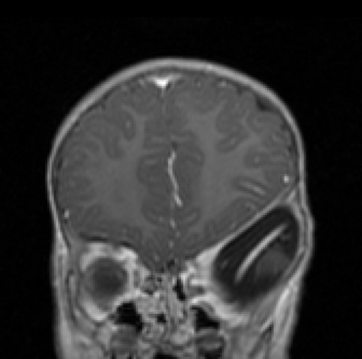 Early diagnosis of Neurofibromatosis type II | Nervous System Disorders