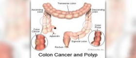 Early signs of colon cancer