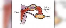Chances of Getting Pregnant with One Fallopian Tube Blocked