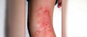 Eczema and food allergies