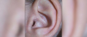 Eczema cure in children