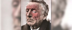 Eczema on face treatment