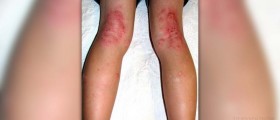 Eczema on feet