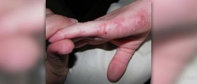 Eczema on hands