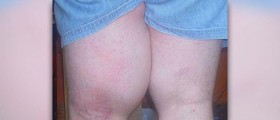 Edema symptoms facts
