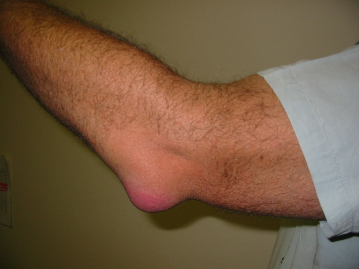 Elbow bursitis treatment | General center | SteadyHealth.com