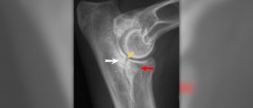 Elbow numbness treatment