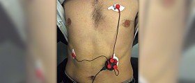 Electrocardiogram stress test