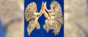 Emphysema life expectancy
