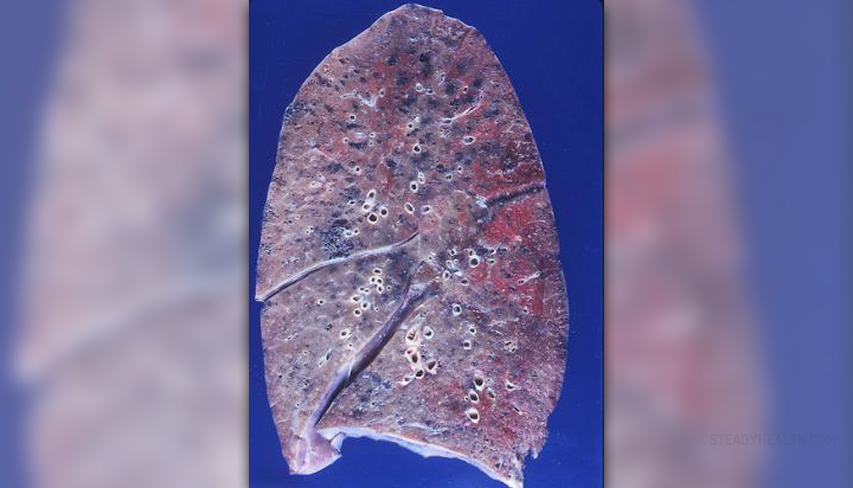 Emphysema lung disease | General center | SteadyHealth.com