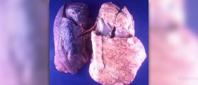 End stage of mesothelioma