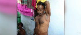 End stage of renal failure