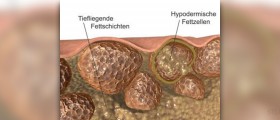 Endermologie cellulite treatment