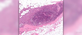 Endocrine therapy for breast cancer