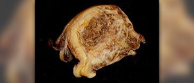 Endometrial cancer facts