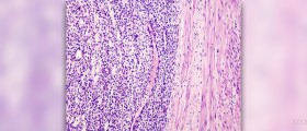 Endometrial hyperplasia facts