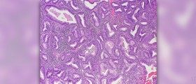 What is endometrial hyperplasia?