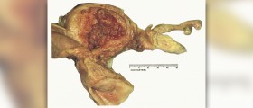 Endometrial benign hyperplasia