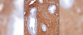 Endometrial polyps symptoms