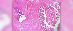 Endometriosis after hysterectomy
