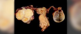 Endometriosis following hysterectomy