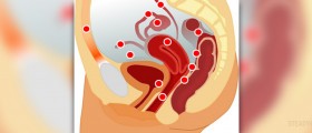 What are the symptoms of endometriosis?
