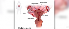 Endometriosis and Trying to Conceive