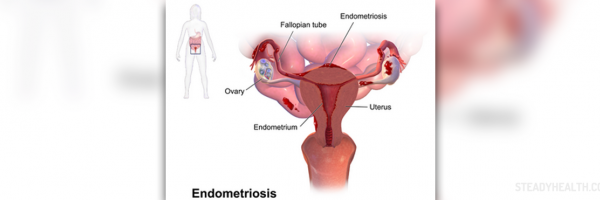Endometriosis Pregnancy Complications and Risks