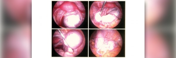 Endometriosis Symptoms Checklist