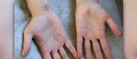 Endoscopic carpal tunnel surgery