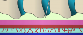 Can you walk around with an epidural in labor?