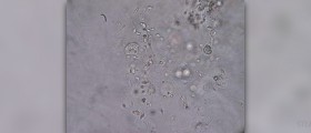 Erectile dysfunction - Low sperm count