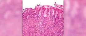 Erosive gastritis facts