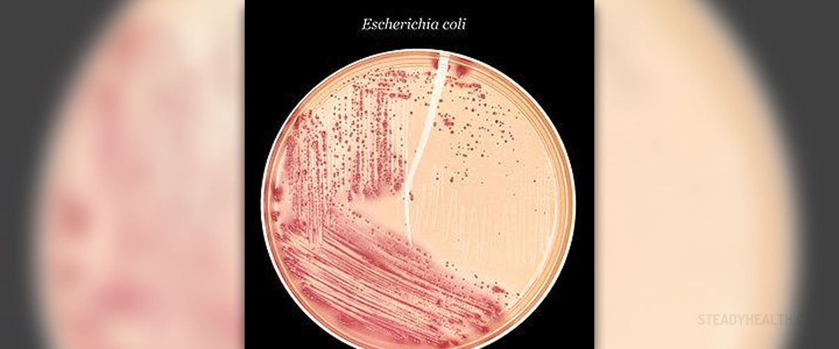 Escherichia coli symptoms in urine | Urinary Tract Issues articles
