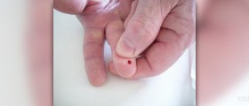ESR blood test