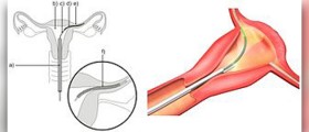 Essure birth control