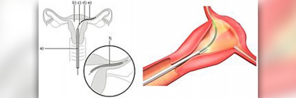 Essure birth control